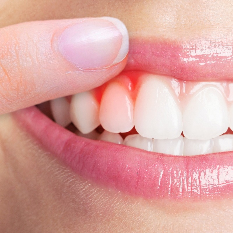 REGUM GEL - γέλη ανάπλασης ούλων